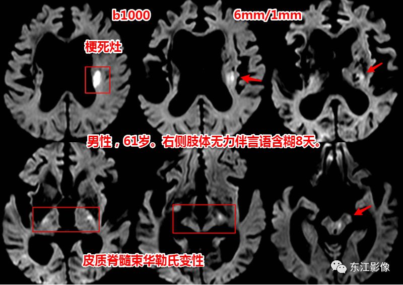 dwi挑戰了傳統的說法——2周後mri才能顯示華勒氏變性.圖21.