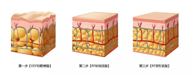 從3-7cm不等(一般指腰圍),脂肪被擊碎後需要時間代謝,20%脂肪層減少