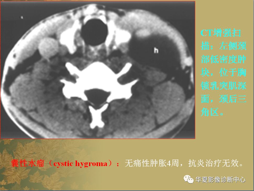 常見有:鰓裂囊腫,甲狀舌骨囊腫,皮樣囊腫,囊性水瘤,血管瘤等.