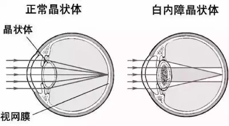 与晶状体浑浊程度和部位有关,有的表现为近视,白内障过熟晶状体膨胀