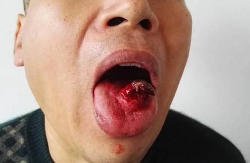 吃槟榔舌癌症患者图片图片