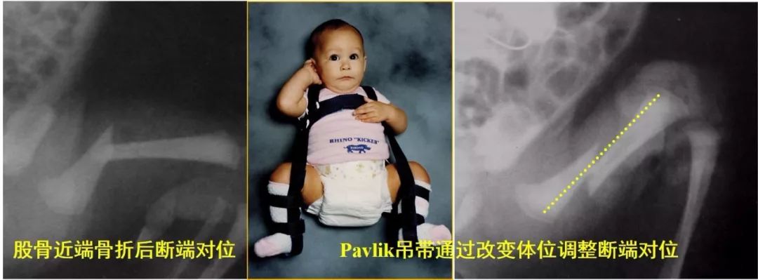 pavlik支具图片