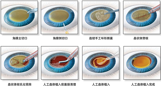 武漢白內障導致失明真的沒救了嗎?眼後部結構和功能正常可以復明