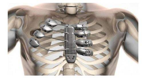 塊頭蓋骨,甚至澳大利亞公司csiro可以為病人量身定做鈦制的胸骨和肋骨