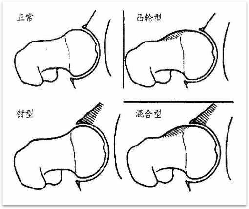 髋关节盂唇位置图片图片