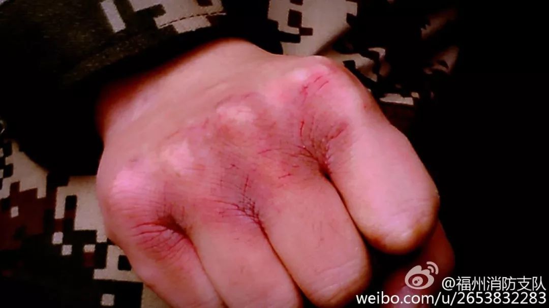 消防战士手臂受伤图片图片