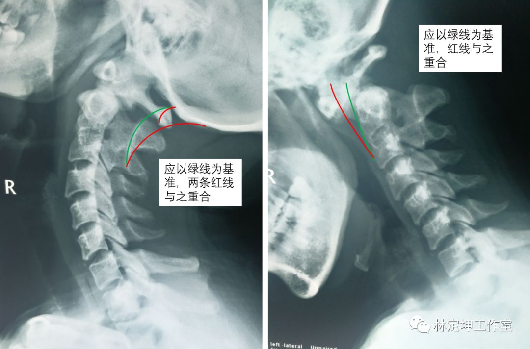 施女士颈椎x线侧位片,可见颈2/3椎体融合畸形,枢椎的齿状突看不清今年