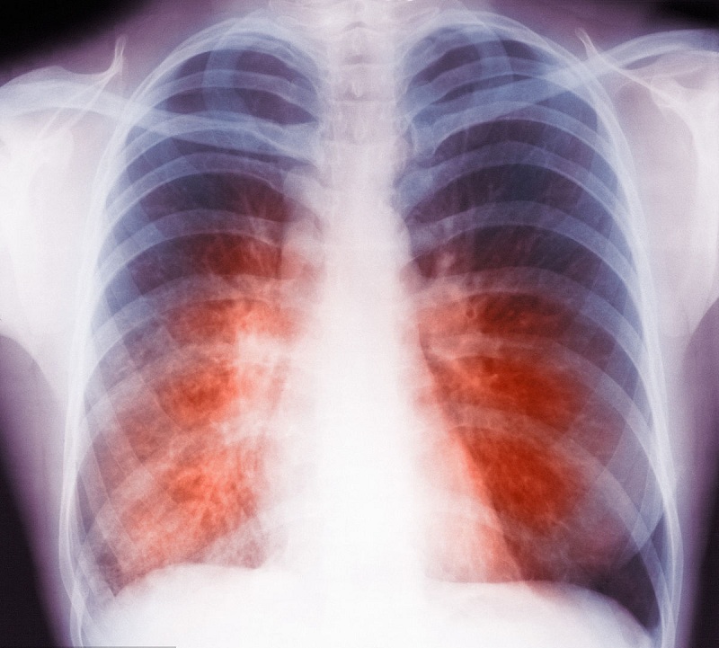 肺结核患者病灶中出现了钙化意味着什么，居然对于排除肺癌有帮助