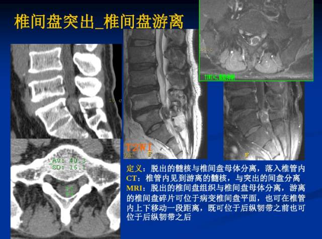 腰椎间盘突出症的影像学诊断和治疗