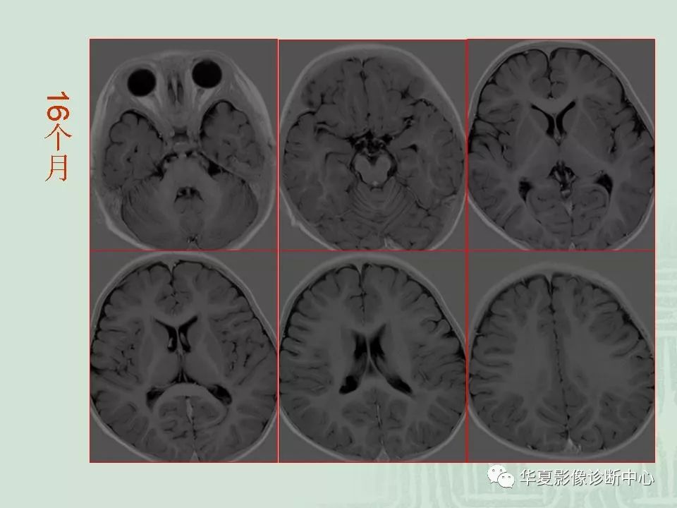 正常小儿颅脑的磁共振表现