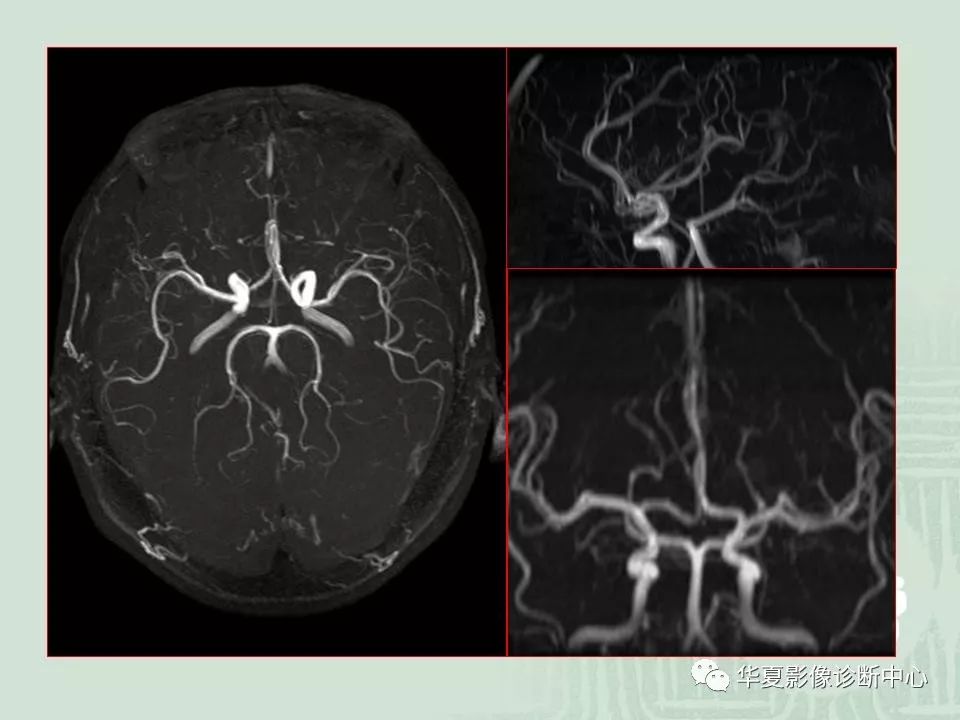 正常小儿颅脑的磁共振表现