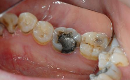 牙齿缺损治疗费用大概要多少?