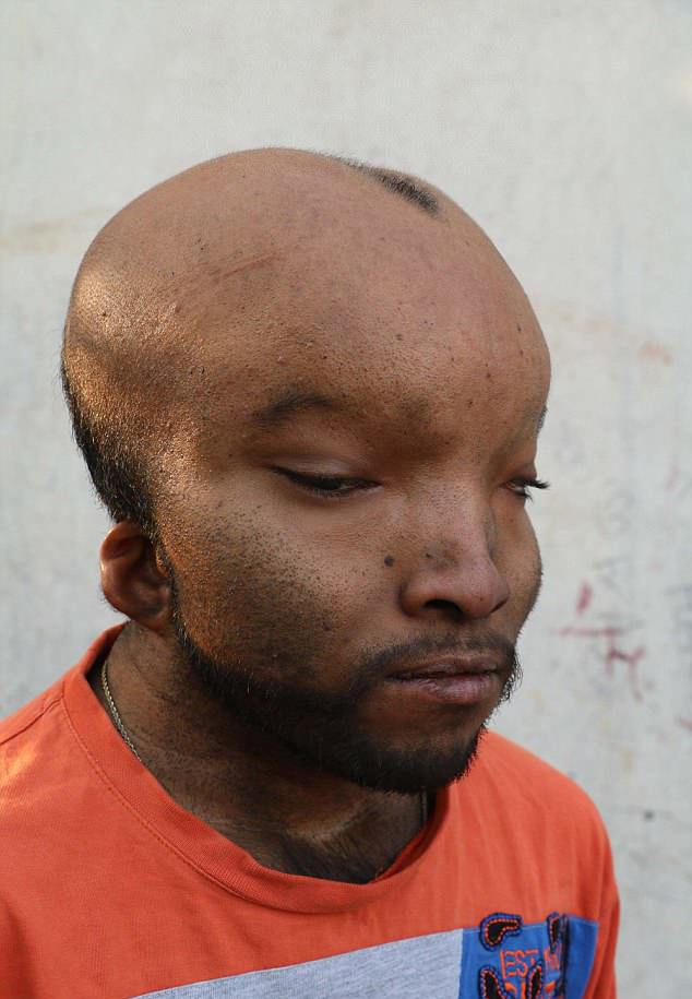 21岁印度男子患怪病,头部异常的巨大,如同外星人