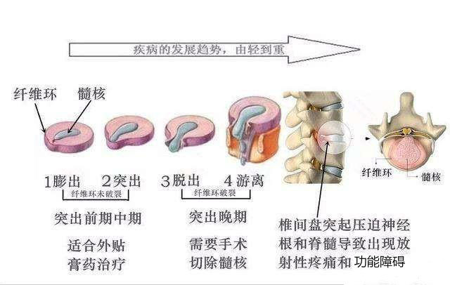 膨出和突出有区别吗图片