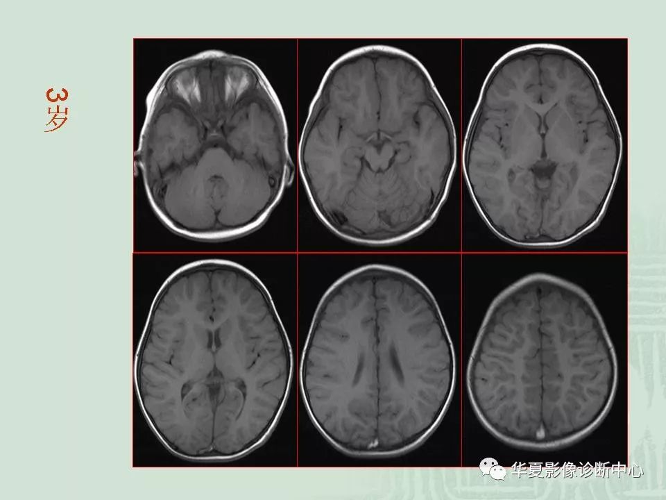 正常的脑部磁共振图片图片
