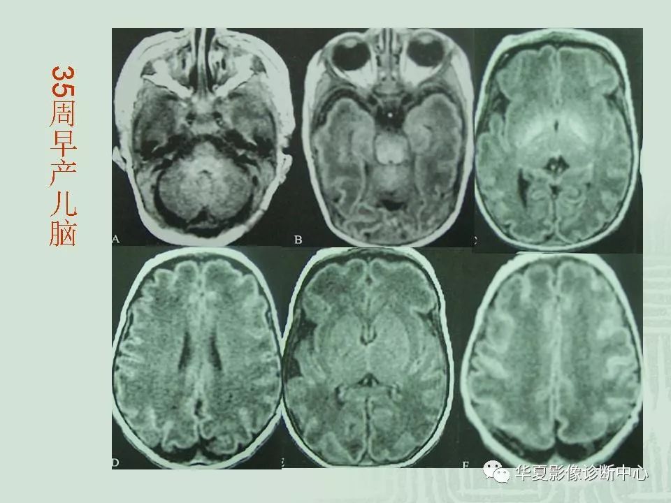 正常小儿颅脑的磁共振表现