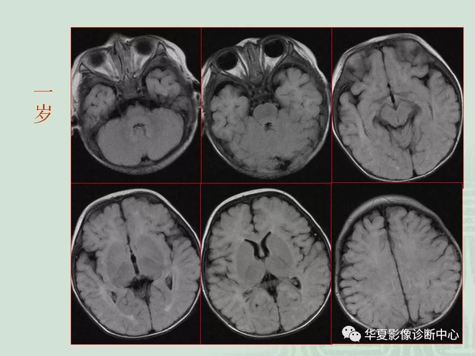 正常小儿颅脑的磁共振表现