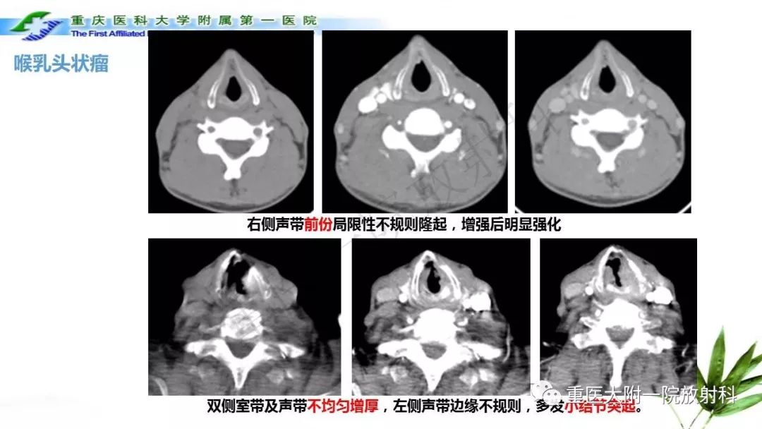 喉部解剖及t分期影像诊断