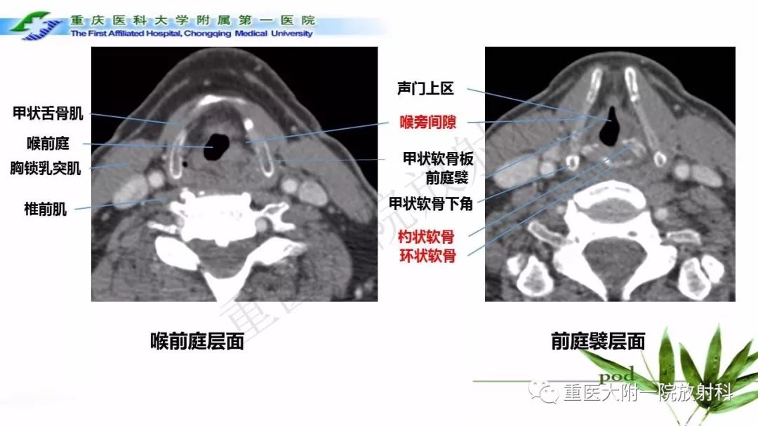 喉部解剖及t分期影像诊断