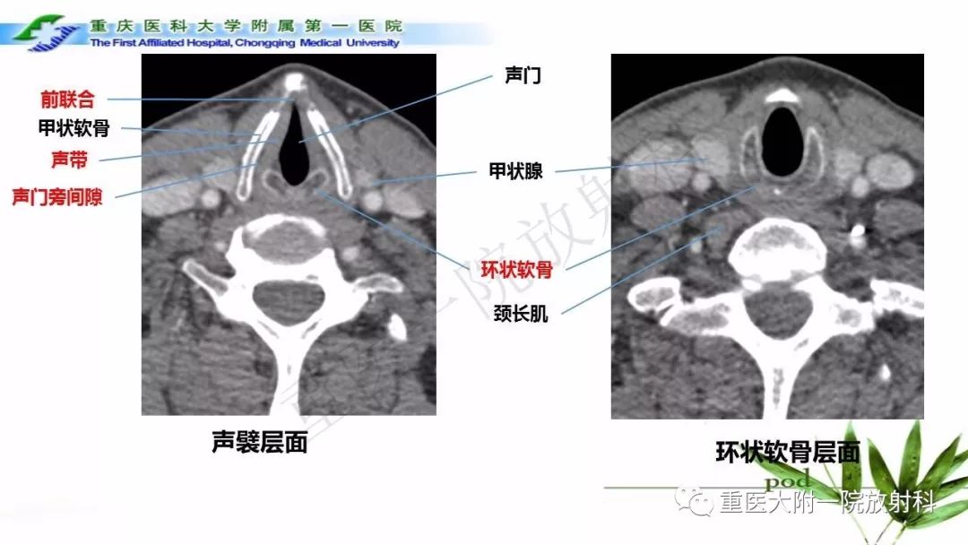 喉部解剖及t分期影像诊断