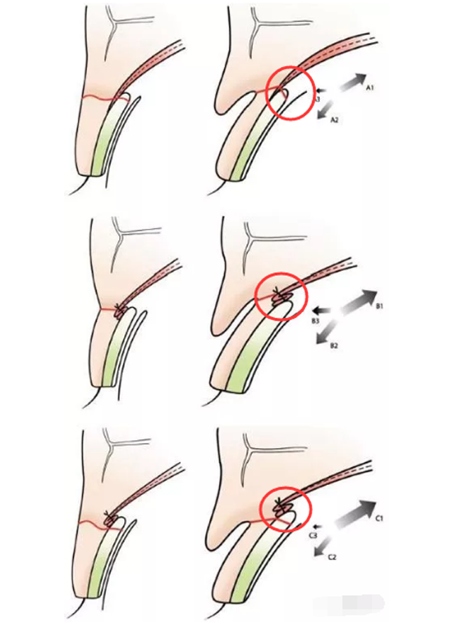 埋线双眼皮的原理图片图片