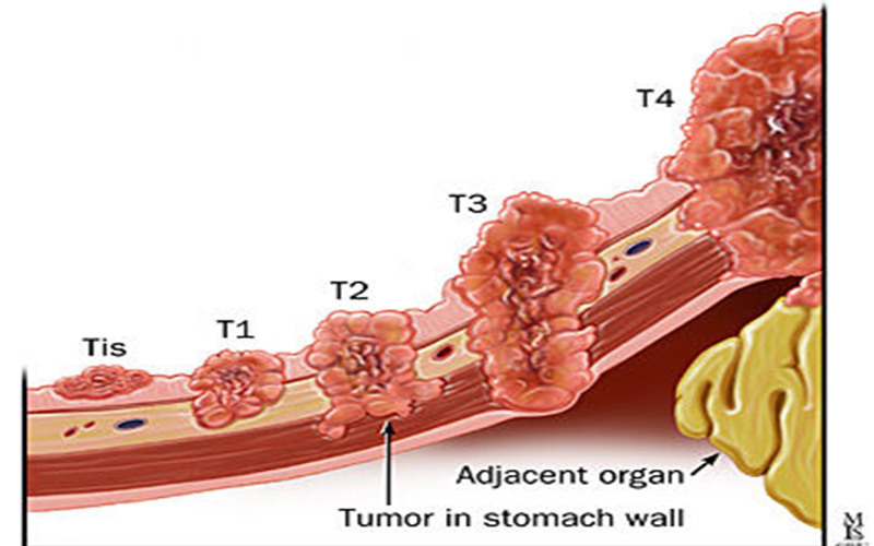 胃癌的演变过程图图片