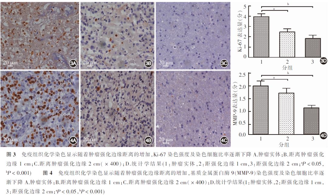 肿瘤细胞计数,免疫组化结果与距肿瘤实体距离的关系(图2~4:随着距离