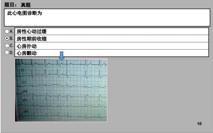 清时记住室上速往往 两格室性期前收缩:宽大畸形 qrs 波室性心动过速