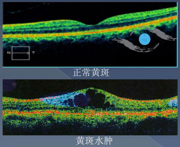 眼鏡驗光師培訓:白內障手術所引發的黃斑水腫的防治