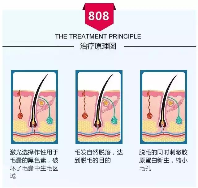 激光脱毛原理图片