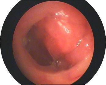 咽鼓管圆枕增生图片