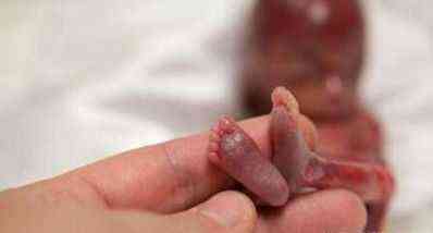 堕胎胎儿图片