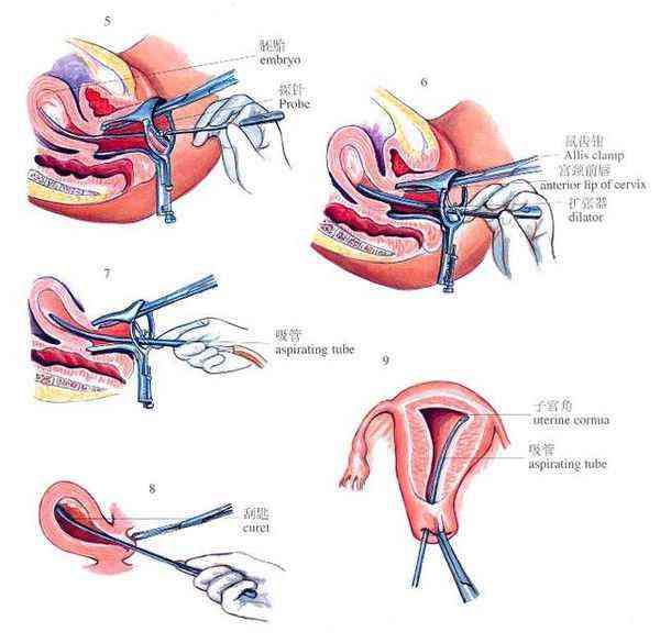 射频减胎术手术过程图图片
