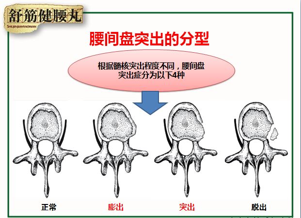 舒筋健腰丸温馨提示腰椎间盘突出的类型及常见并发症