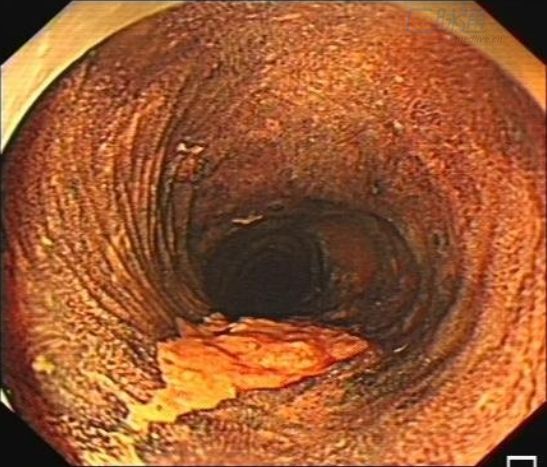 食管癌缩窄型图片图片