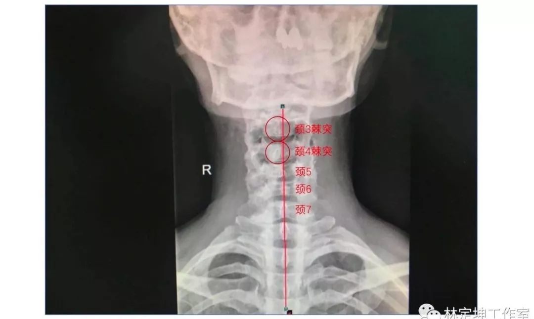 颈椎双斜位x光片图片