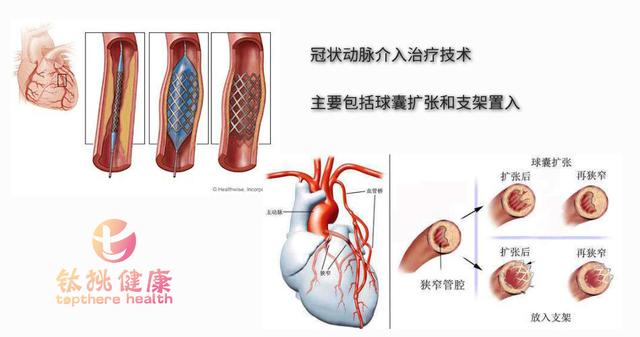 冠状动脉血管成形术究竟是什么