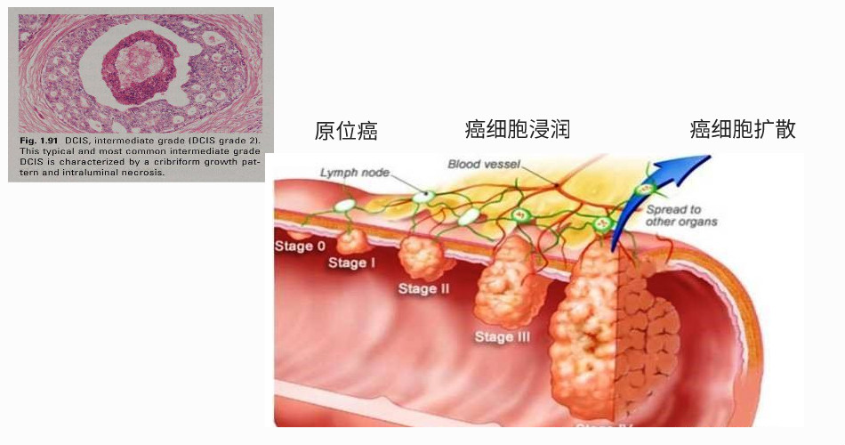 原位癌浸润癌图片