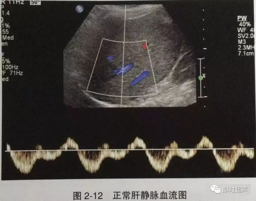 肝脏超声诊断