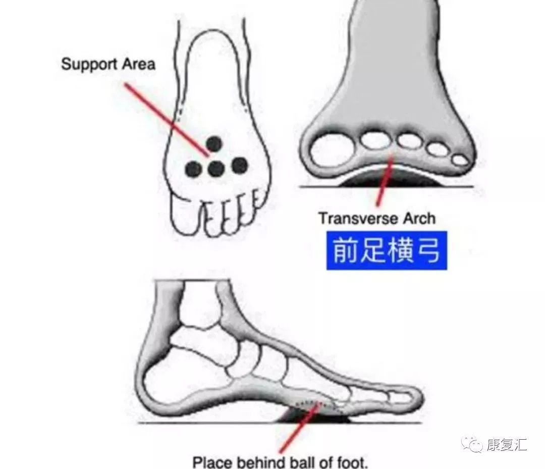 足弓是由足底的骨性结构(跗骨和跖骨等)以及软组织(足底的韧带,肌腱等