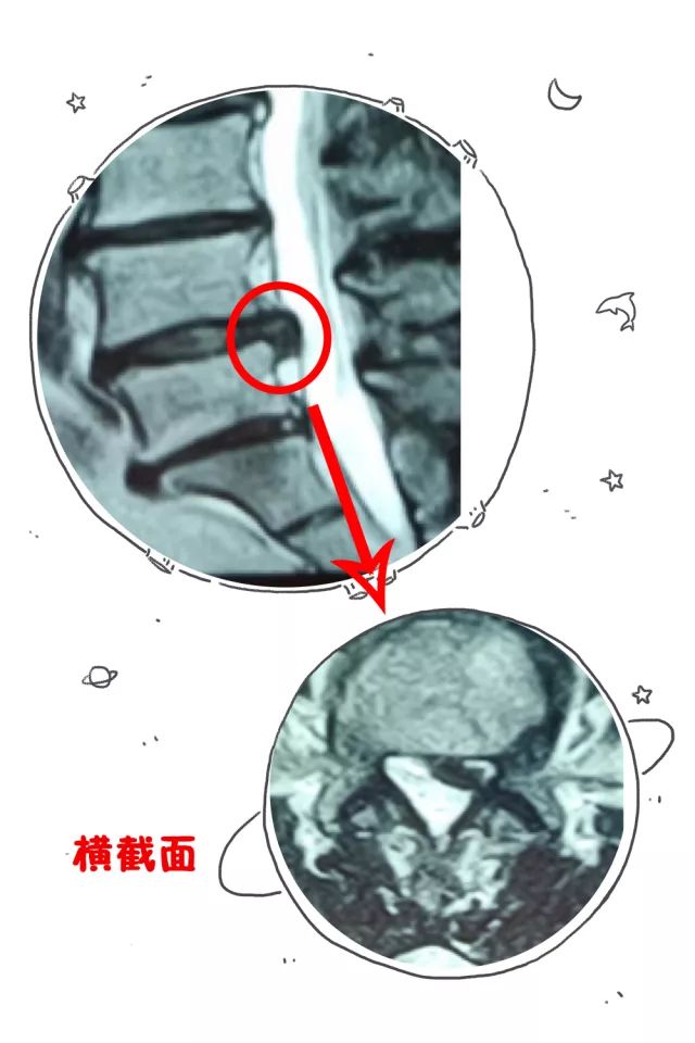 腰椎間盤突出壓迫神經導致急性疼痛,馬上聯繫安排行腰椎磁共振檢查