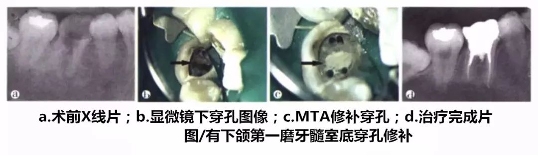 【牙医学堂】开髓时,你遇到过如下问题吗?