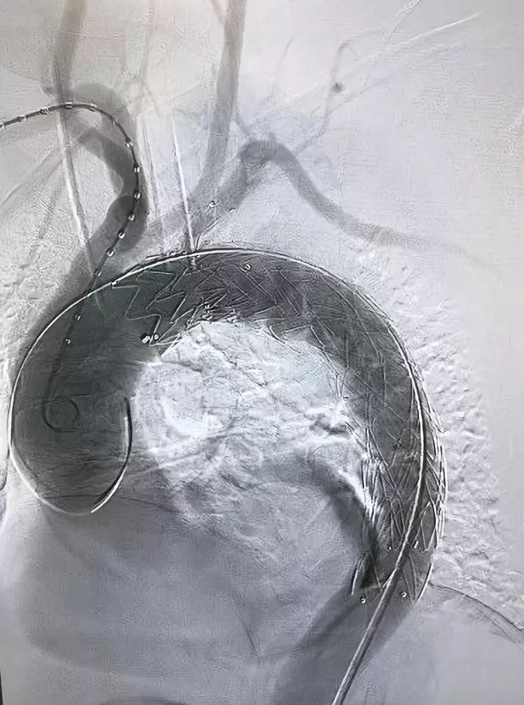 主动脉覆膜支架图片