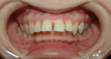 有哪些方法可以矫正龅牙?
