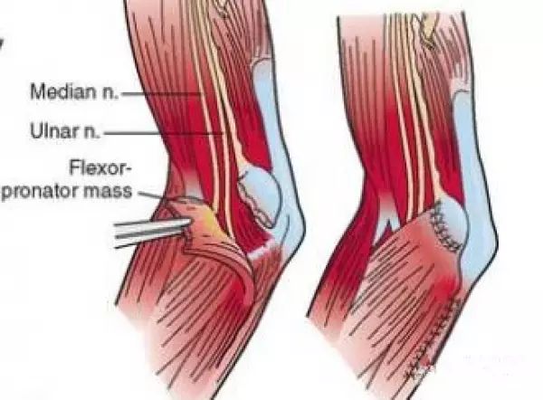 鬆解:打開拱廊,打開肌間隔,腱膜後將尺神經前置於屈肌腱.