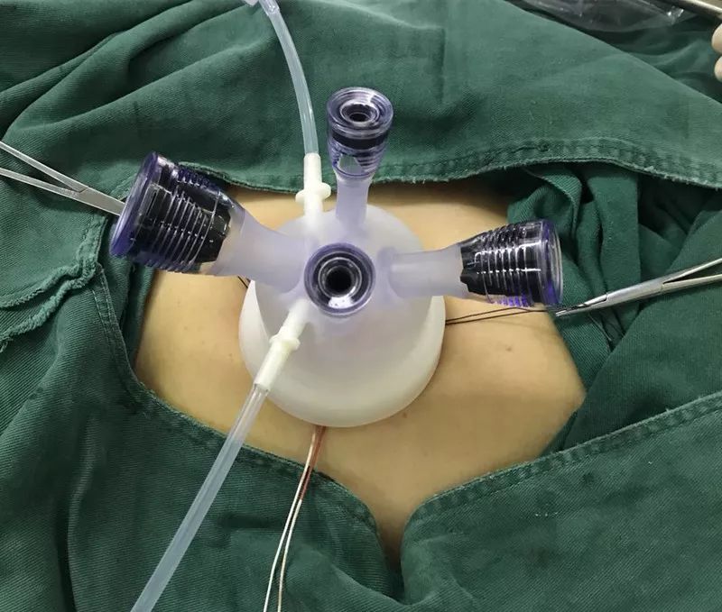 首例经脐单孔腹腔镜子宫全切术获得成功,我院妇科微创手术进入无疤