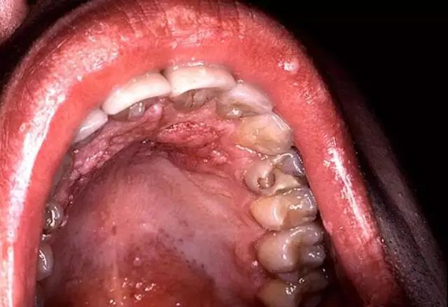 口腔黏膜癌图片