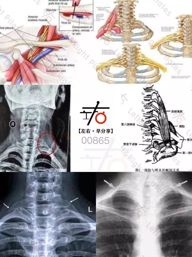颈肋综合征图片