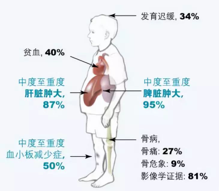 脾大人体图片