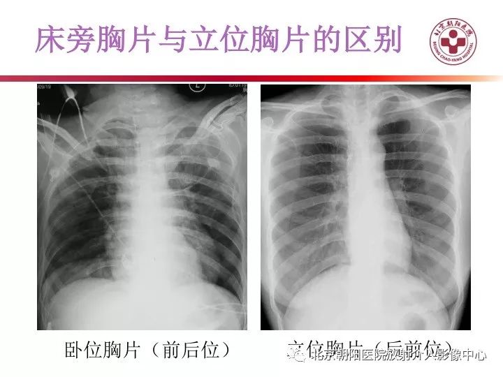 (左圖:床旁胸片;右圖:正位胸片---立位)(黃箭:氣管插管頂端位置;綠箭